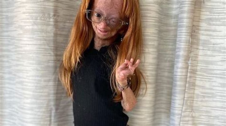 Adalia Rose Williams dead at 15 'She is no longer in pain'
