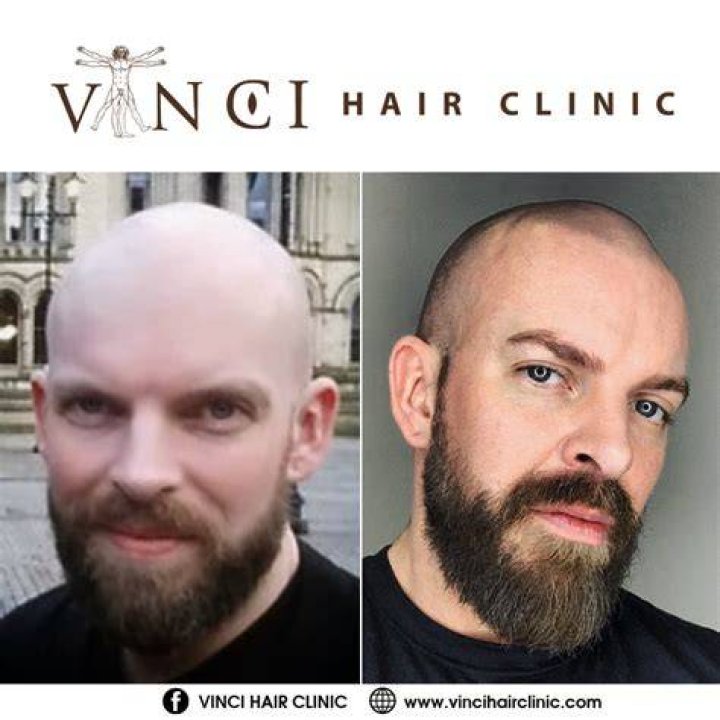 bald vs not bald