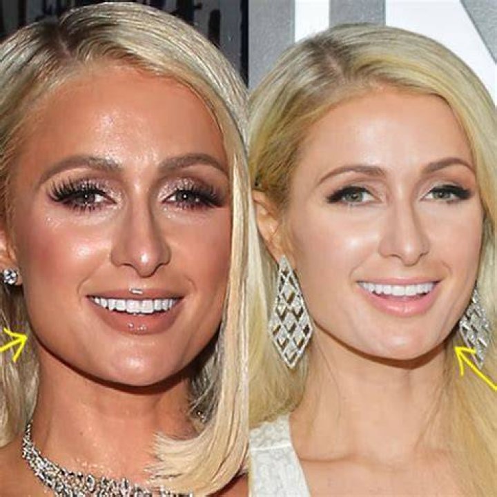 Did Paris Hilton Get Plastic Surgery? The Heiress&rsquo; Quotes about Botox