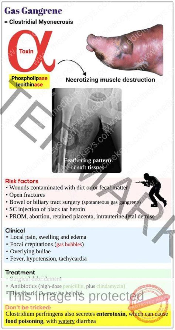 Laboratory Medicine – Gas Gangrene