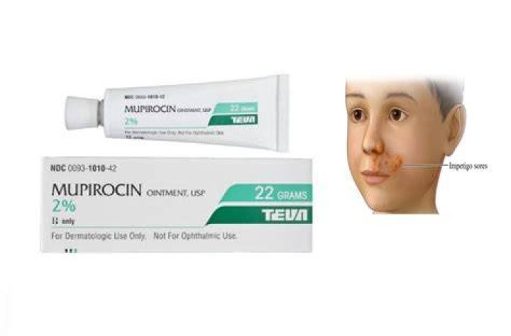 Mupirocin Ointment for Perioral Dermatitis