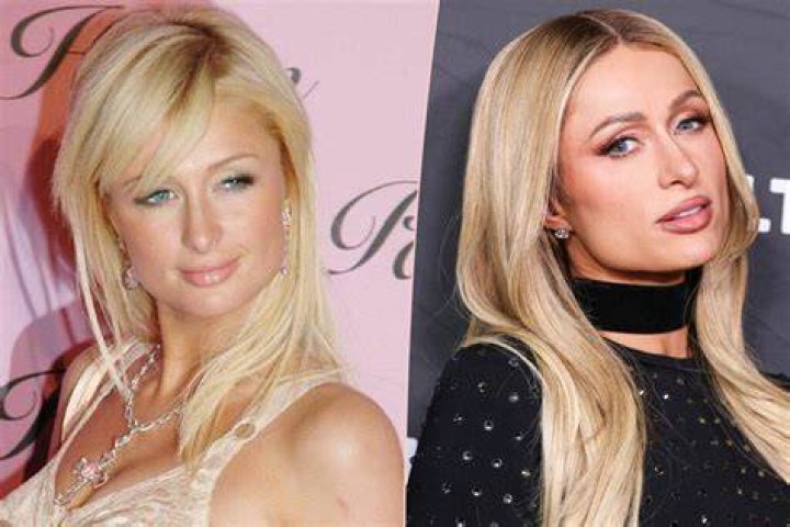 Paris Hilton Has Never Had Plastic Surgery or Botox 'I've Always Been