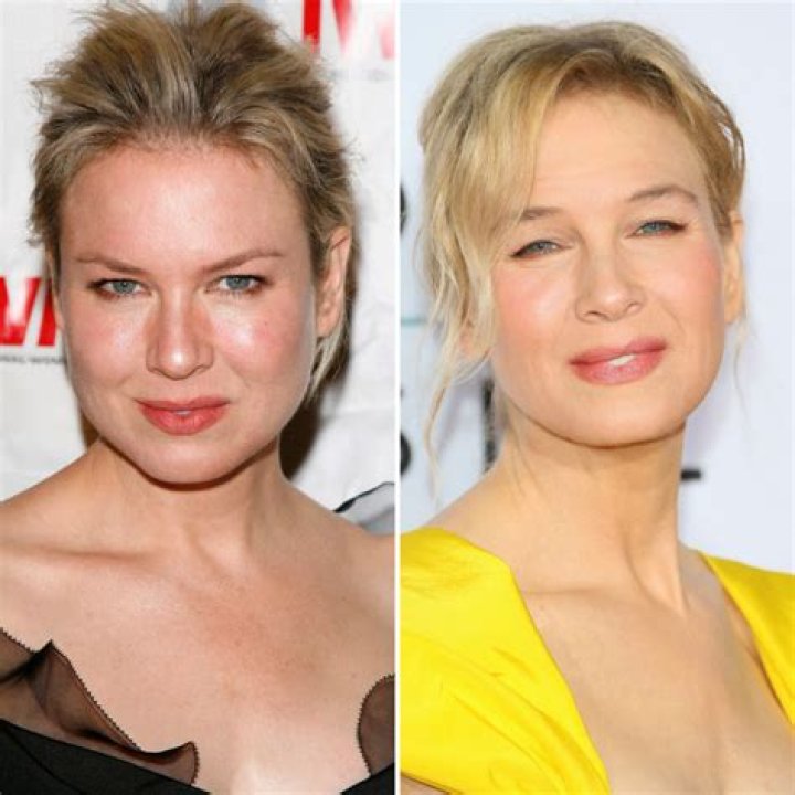 Renee Zellweger, Plastic Surgery Before and After